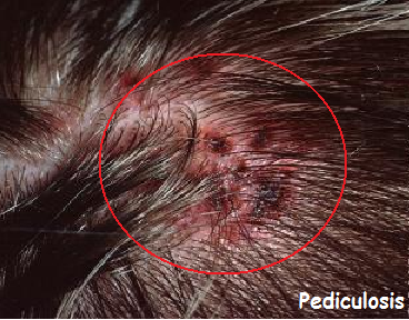 what is pediculosis